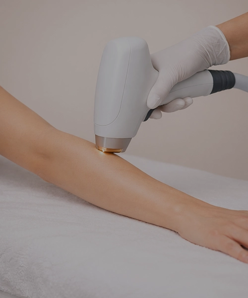 Лазерная эпиляция