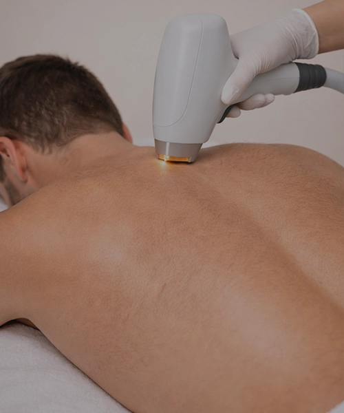 Лазерная эпиляция