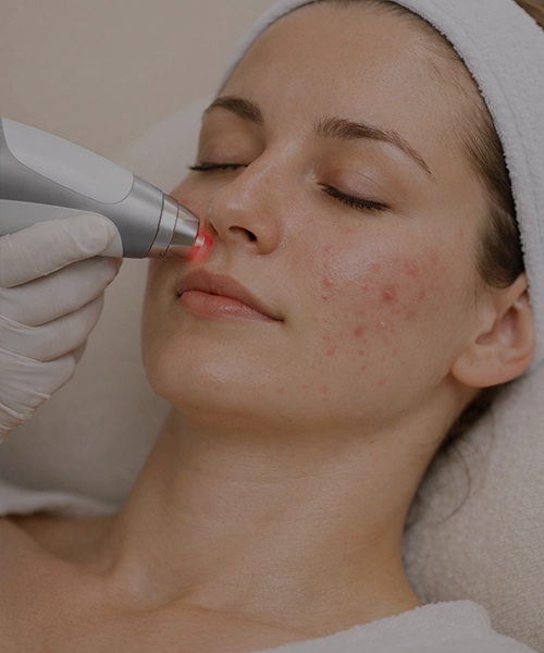 Лазерное лечение акне