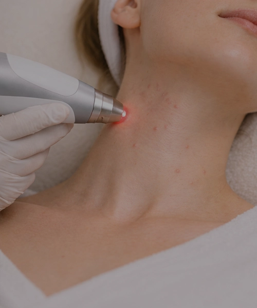 Лазерное лечение акне