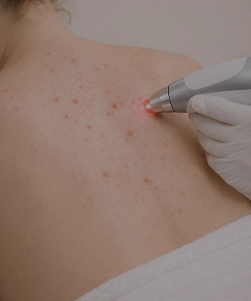 Лазерное лечение акне