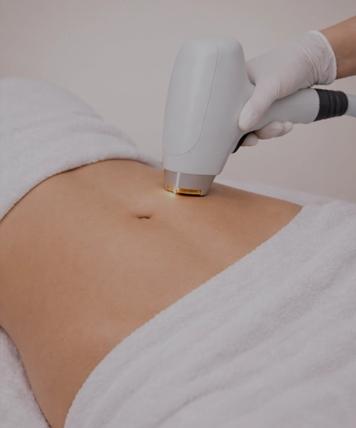 Лазерная эпиляция