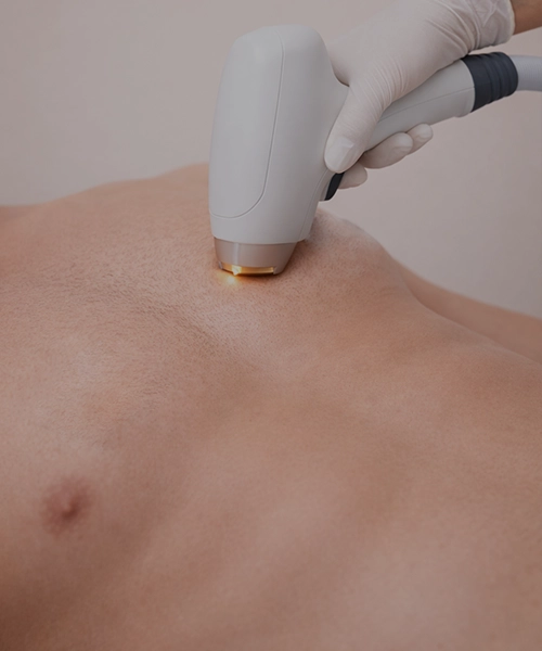 Лазерная эпиляция